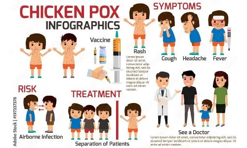 Increase in Chickenpox Cases Among School Children Observed in Hyderabad City