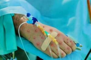 Mpox No Longer Considered a Global Health Emergency by WHO