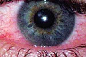 Eye infections on the rise in schools