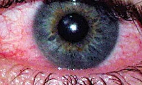 Eye infections on the rise in schools