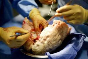 First Lung Transplant Surgery Conducted under Aarogyasri by NIMS Doctors in Hyderabad