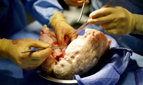 First Lung Transplant Surgery Conducted under Aarogyasri by NIMS Doctors in Hyderabad