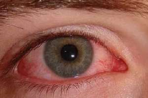 Increase in Conjunctivitis Cases Noticed in Telangana