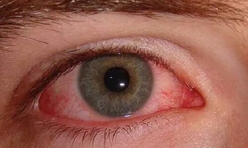 Increase in Conjunctivitis Cases Noticed in Telangana