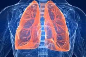 Increasing Number of Non-Smoking Women Diagnosed with Lung Cancer