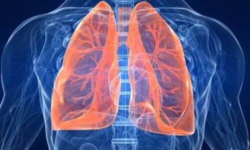 Increasing Number of Non-Smoking Women Diagnosed with Lung Cancer