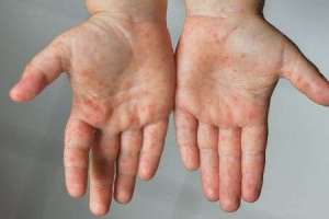Skin diseases spread as a result of contaminated water from dump yard power unit in Hyderabad
