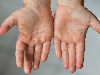 Skin diseases spread as a result of contaminated water from dump yard power unit in Hyderabad
