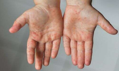 Skin diseases spread as a result of contaminated water from dump yard power unit in Hyderabad