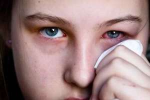 Surge in Seasonal Diseases and Significant Increase in Conjunctivitis Cases Observed in Hyderabad