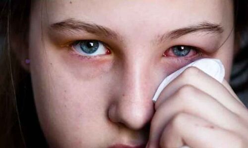 Surge in Seasonal Diseases and Significant Increase in Conjunctivitis Cases Observed in Hyderabad
