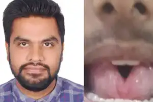 ENT surgeons restore young man’s quality of life with tongue surgery