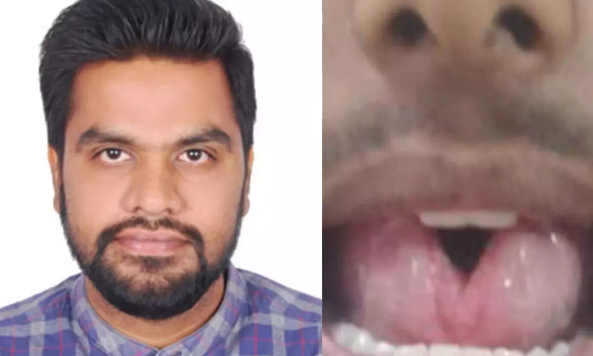 ENT surgeons restore young man’s quality of life with tongue surgery