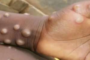 Hyderabad on High Alert as WHO Declares Mpox a Global Emergency