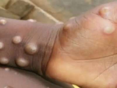 Hyderabad on High Alert as WHO Declares Mpox a Global Emergency
