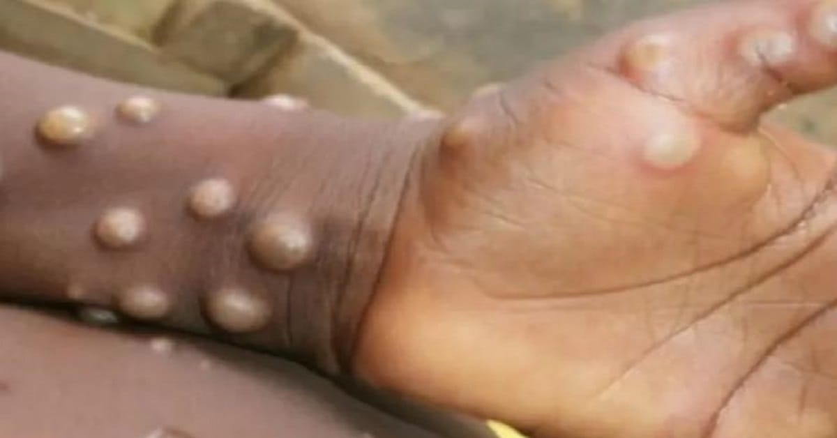 Hyderabad on High Alert as WHO Declares Mpox a Global Emergency