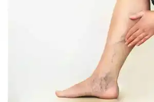 25% of Indians Affected by Varicose Veins