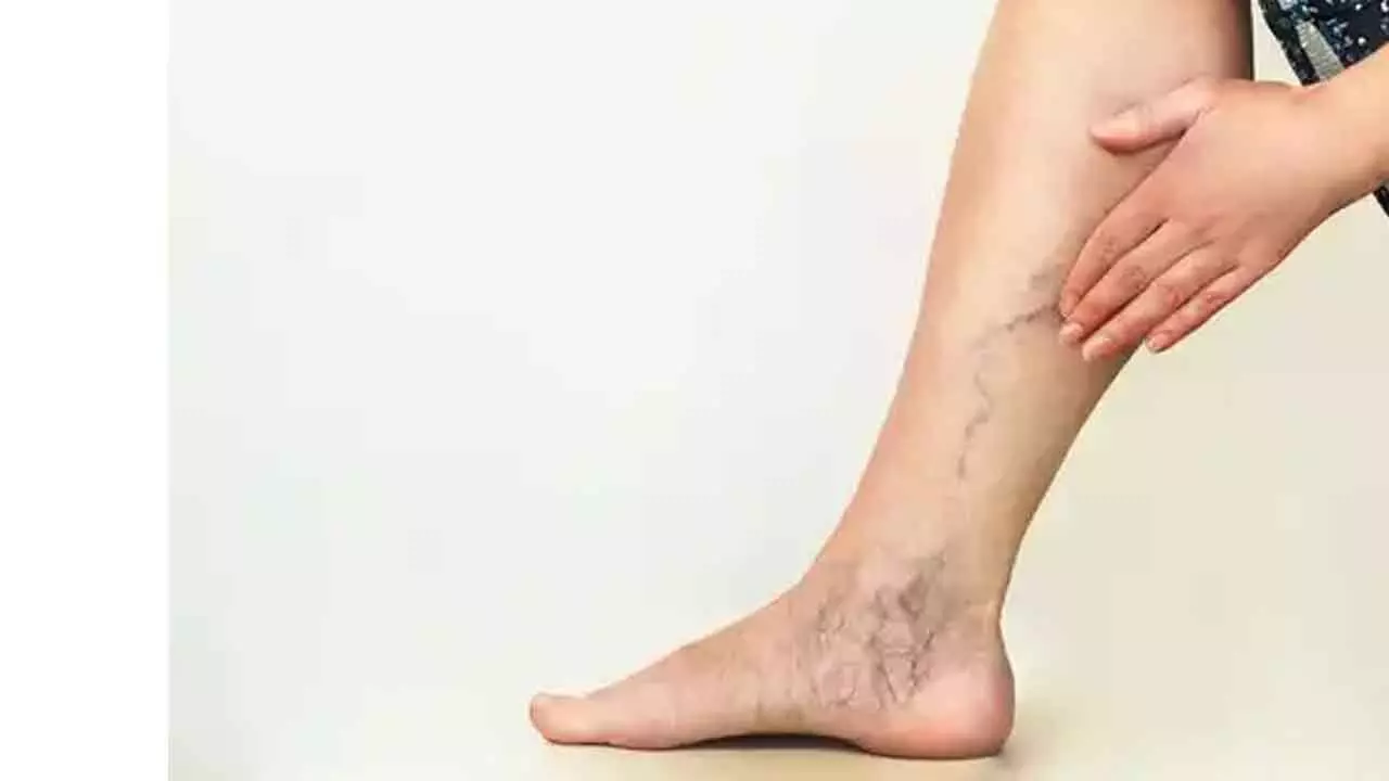 25% of Indians Affected by Varicose Veins