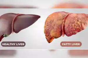More than 80% of Indian IT employees have Fatty Liver Disease, UoH study finds