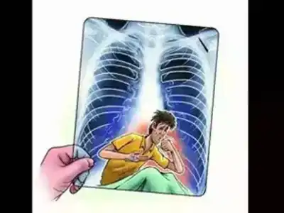 Telangana wins national award for 100-day TB elimination campaign