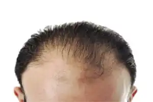 Baldness Scam Tricks Hundreds in City