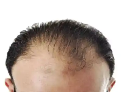 Baldness Scam Tricks Hundreds in City